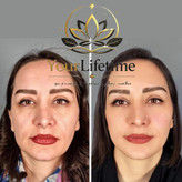 کرم بیوممتیک ضدچین و چروک صورت گاتیو بوتاکس ۵ کاره ۴۰ml