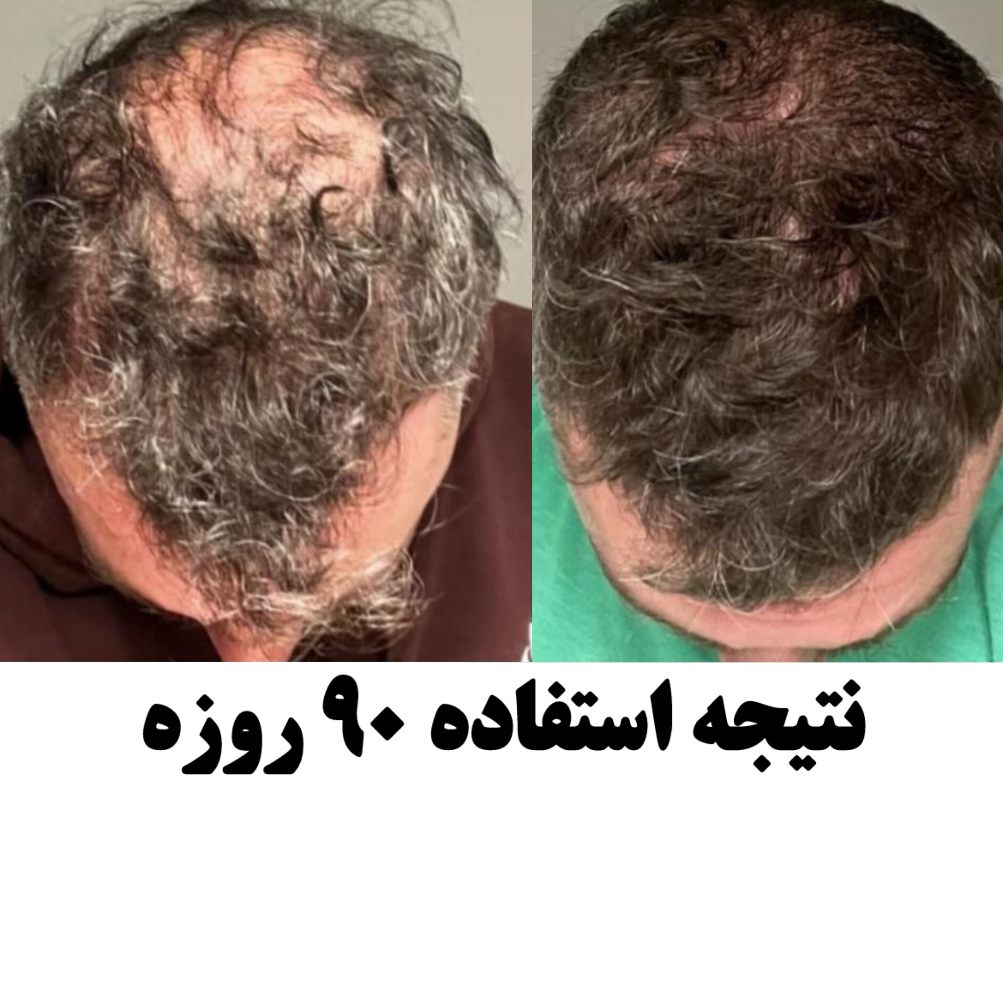 تونیک سولوشن امریکایی-ضدریزش و محرک رشد مجدد مو بدون اپلیکاتور اصل بیوممتیک - EXONIC